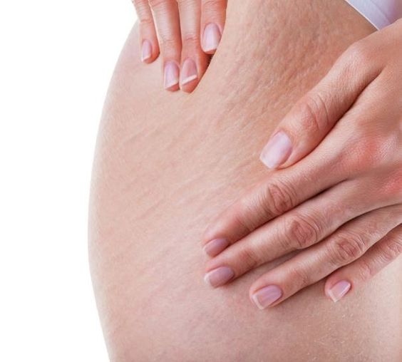 Cellulite: What It Is, Causes and Treatment